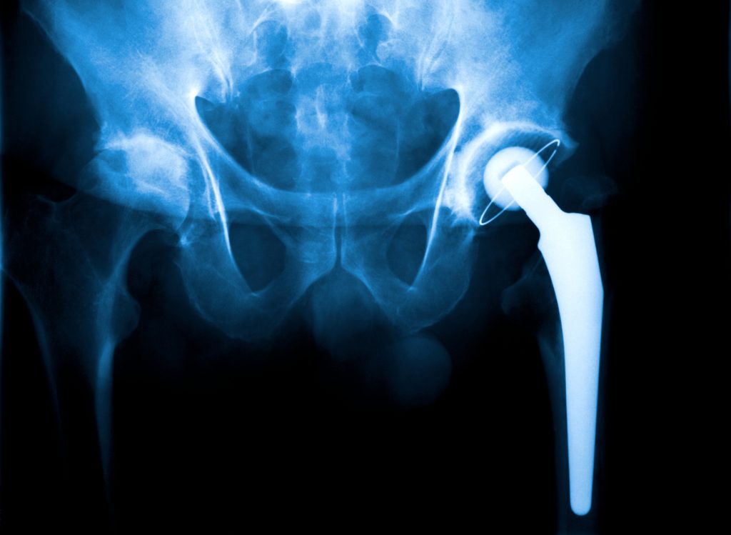 An X Ray of a hip joint problem