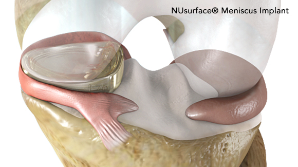 OrthoForum Member Performs Meniscus Replacement Using NUsurface Technology